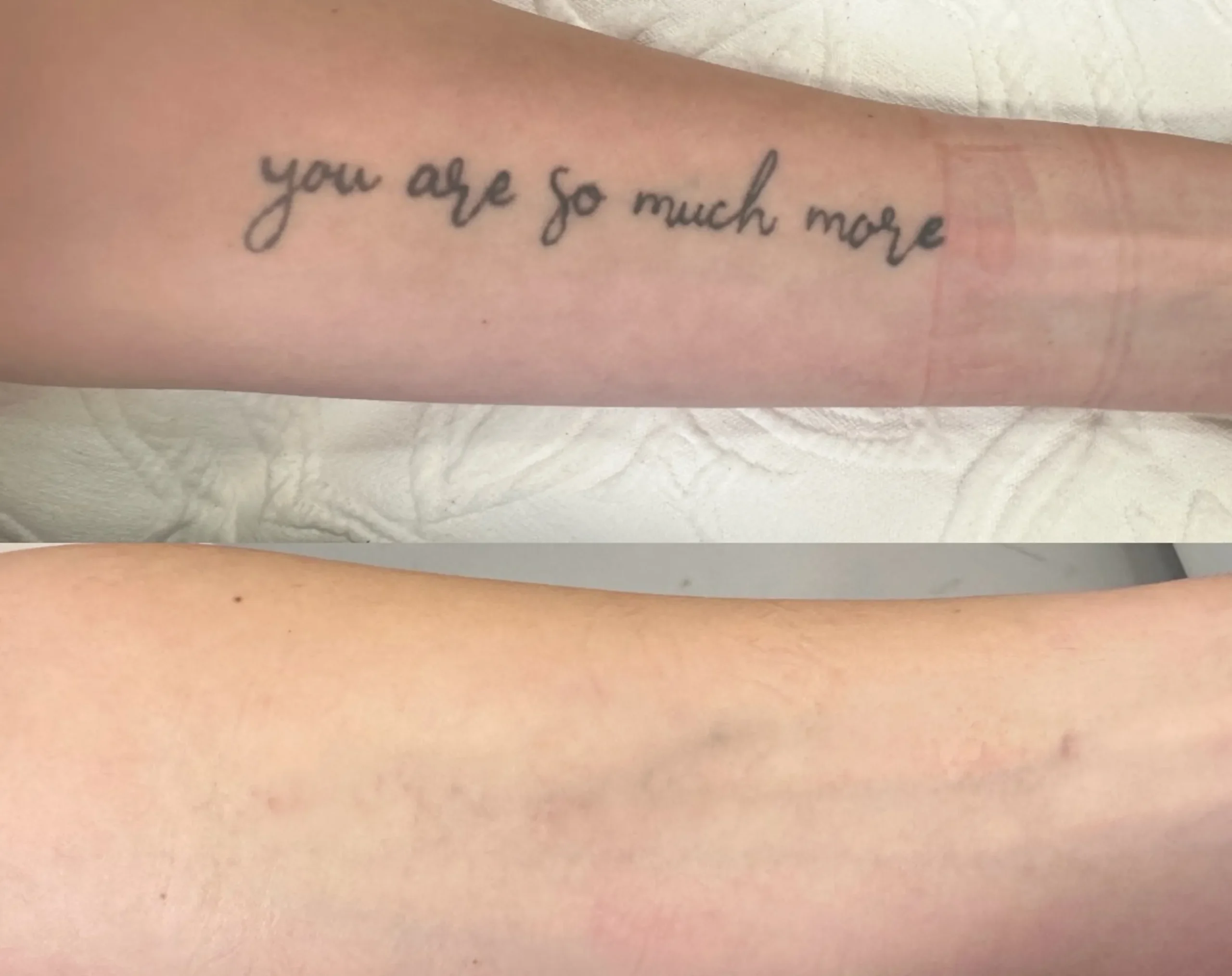 cosmetic tattoo removal safety face