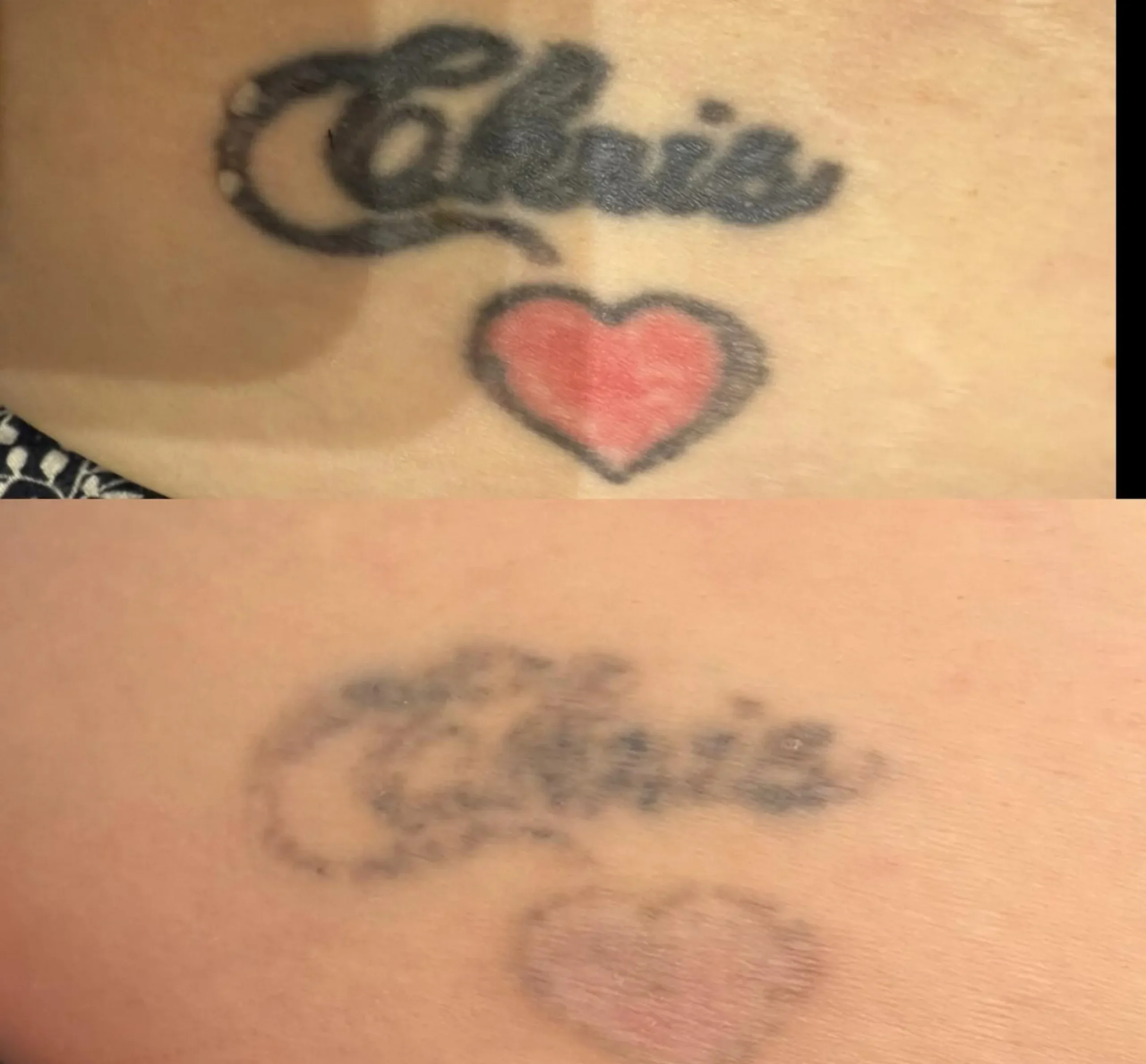 laser depth tattoo pigment dermis