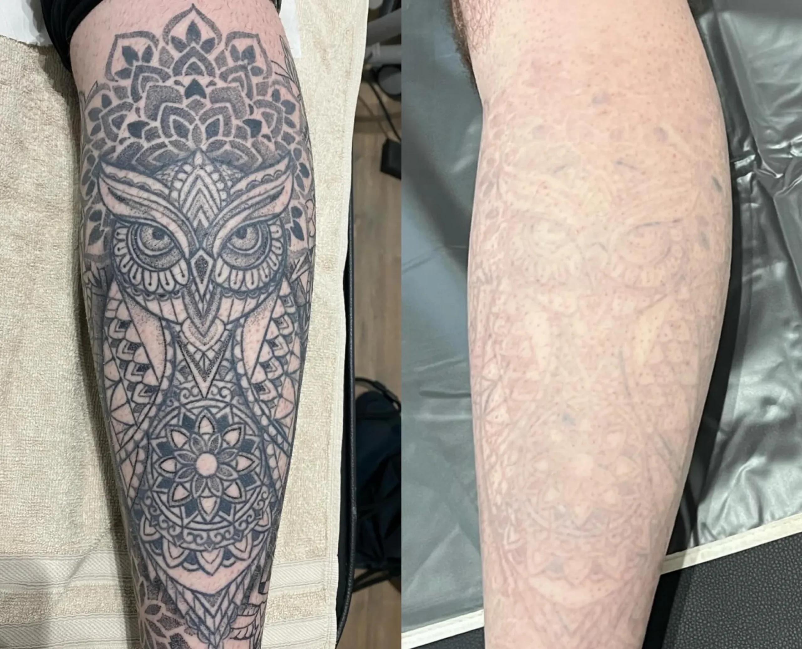 laser tattoo removal hair follicles