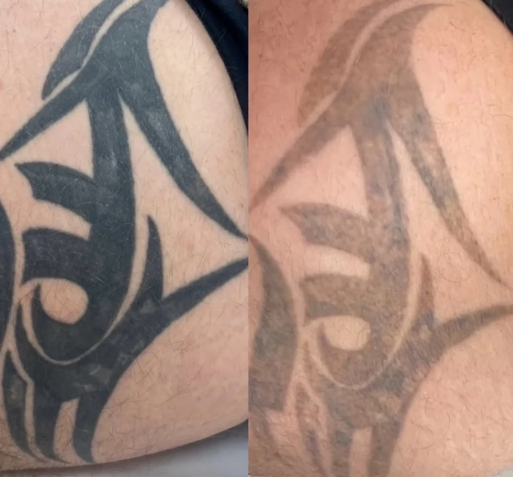 tattoo removal nerve damage myth